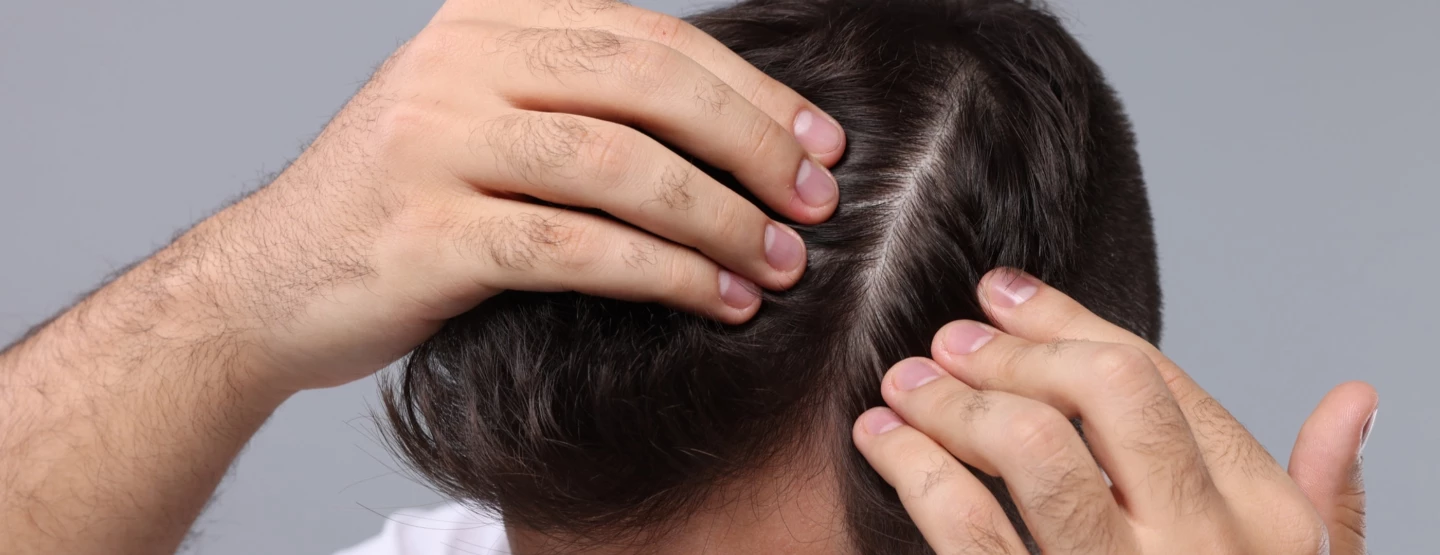 Hairloss-1
